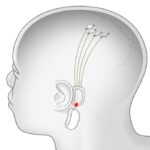 Neuralink agyi implant Elon Musk