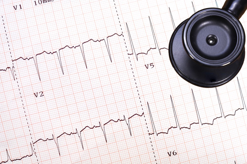 mesterséges intelligencia EKG